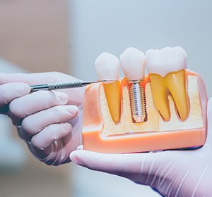 Dentist pointing to model of dental implant