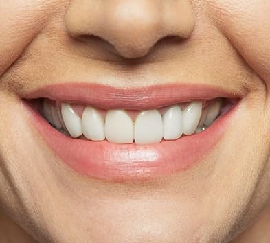 Closeup of perfectly restored smile