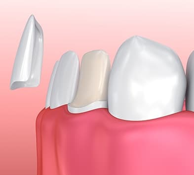 Animation of porcelain veneer placement