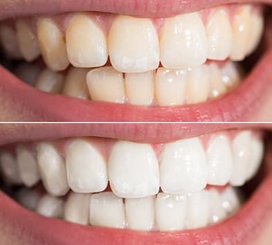 Closeup of smile before and after teeth whitening