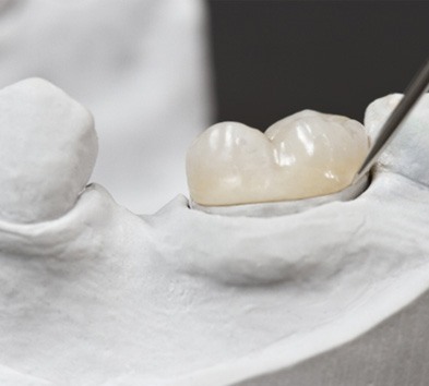 Dental crown on a dental model