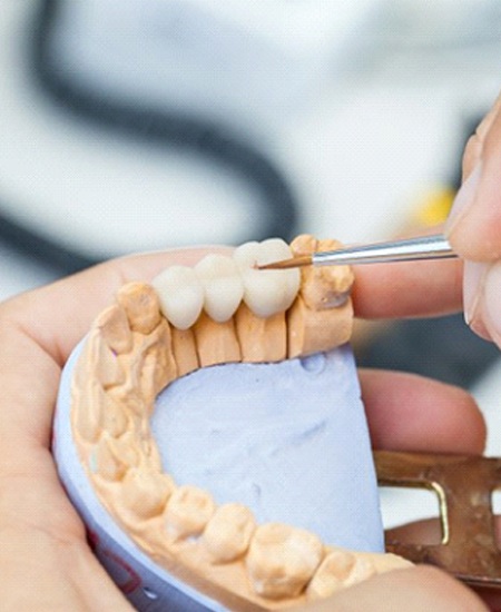 dentist designing a dental bridge in Alexandria, IN