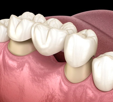 traditional dental bridge replacing a missing tooth