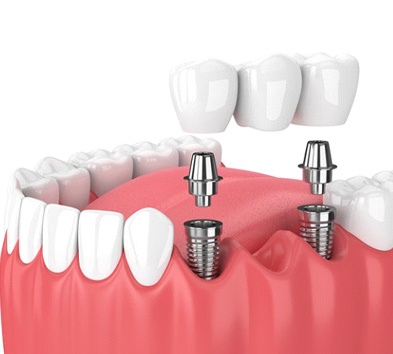 two dental implants supporting a dental bridge