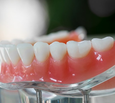 Model denture sitting on a clear stand
