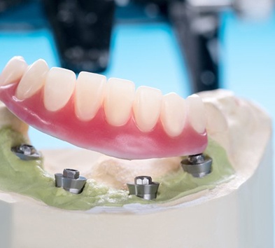 Model of implant dentures and implant posts
