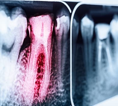 X-ray of root canal treated tooth