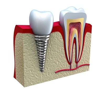 Diagram of an integrated dental implant in Alexandria.