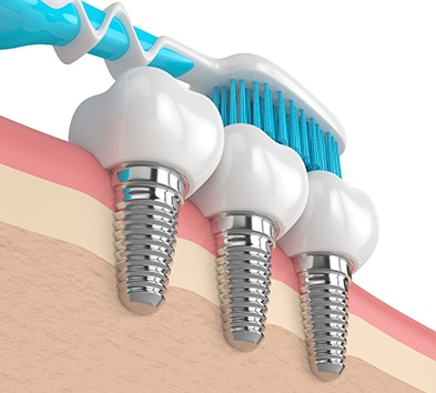 Diagram of a toothbrush cleaning dental implants in Alexandria.