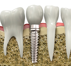 Diagram of an integrated dental implant in Alexandria.