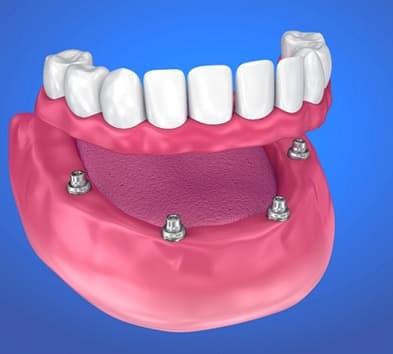 implant denture on the lower arch  