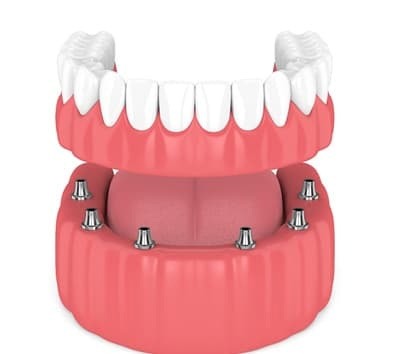 full denture on six dental implants   
