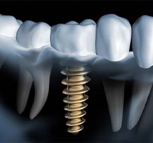 X-ray showing a dental implant