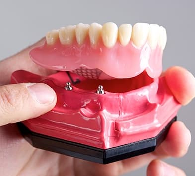 Model of implant supported denture