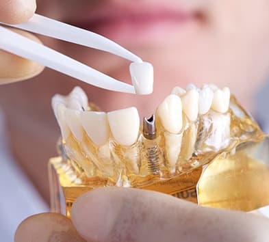 Model of implant supported dental crown