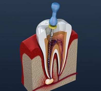 root canal 