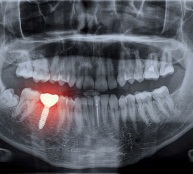 Highlighted X-ray of dental implant failure in Alexandria  