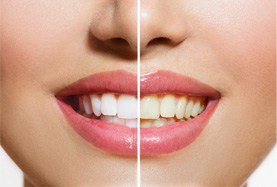 Before and after of teeth whitening