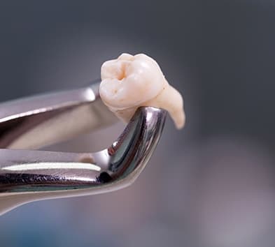 Clasp holding extracted tooth