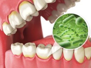 Model detecting gum disease. 