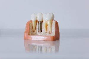 Model of dental implant