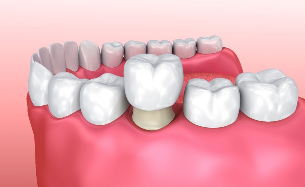 illustration of dental crown